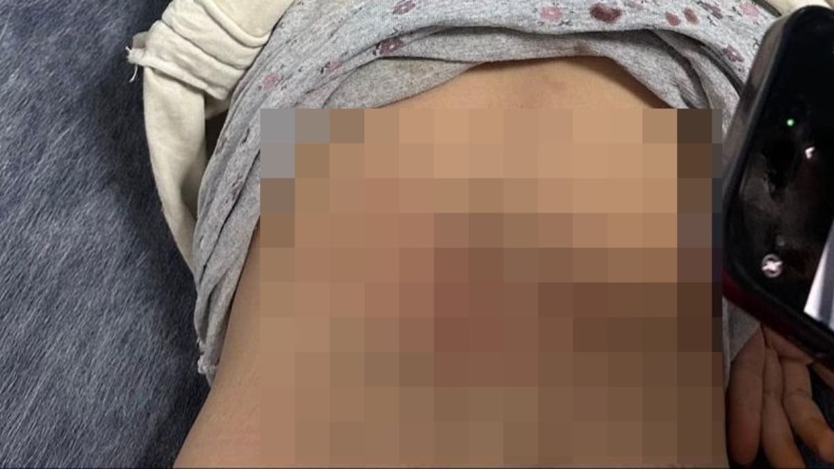 Mardin'de küçük çocuğa başıboş köpekler saldırdı