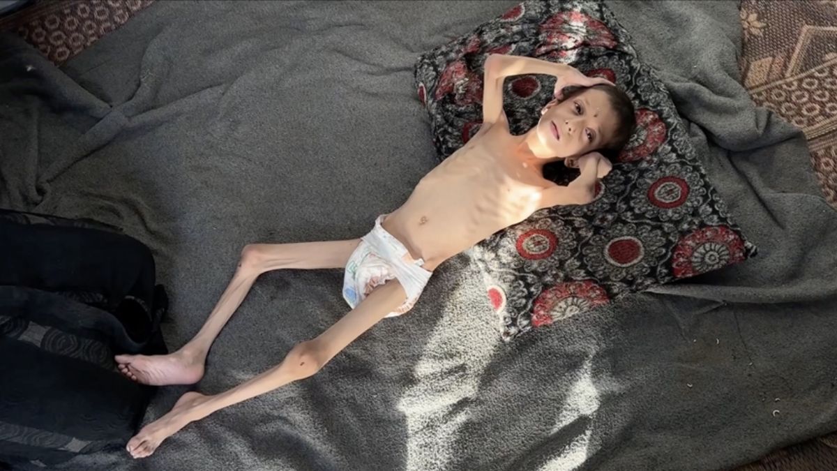 İsrail'in kıtlığa sürüklediği 10 yaşındaki Nafız kemik yığınına dönüştü