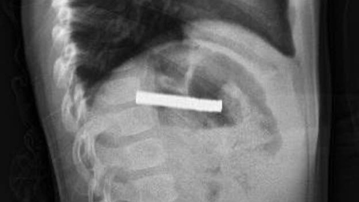 Elazığ'da çocuğun boğazından 19 adet mıknatıs çıkartıldı