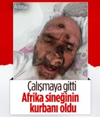 Antalya'da Afrika sineği ısıran adamın yüzünde yaralar çıktı