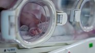 İzmir'de 430 gram doğan prematüre bebeğe kalp ameliyatı