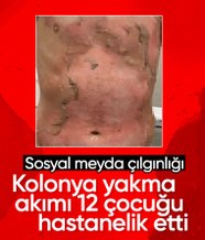 Sosyal medyada kolonya yakma akımı! Hastanelerde yanık servisleri doldu