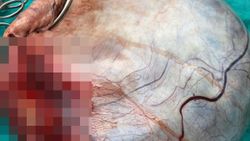Samsun'da hamile sanılan kadının karnından kitle çıktı