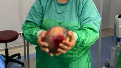 Antalya'da bir hastanın rahminden 1,5 kilo kist çıktı