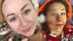 İstanbul'da eşinin falçatayla saldırdığı Hanna, yardım bekliyor