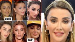 Özge Ulusoy'dan estetik açıklaması