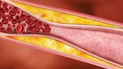 Trigliserid seviyelerini düşürmek için ipuçları