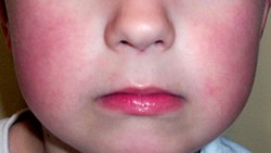 Çocuklarda kırmızı yanak beşinci hastalık belirtisi olabilir