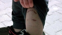 Ankara'da 14 yaşındaki Defne'ye sokak köpekleri saldırdı