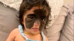 'Batman kız' olarak anılan 2 yaşındaki Luna, doğum lekesinden kurtuldu