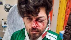 Kırmızı kart gören futbolcu, rakibinin yüzüne tekme atıp yaraladı