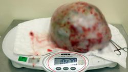 Samsun’da, kadının karnından 10 kilo 470 gram kitle çıkarıldı