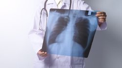 Akciğer kanseri hakkında herkesin bilmesi gereken 7 gerçek