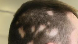 Will Smith'in eşi Jada Smith'in hastalığı: Alopesi nedir