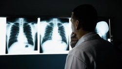Akciğer kanserinde sigara dışında 7 risk faktörü
