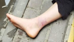 Kastamonu'da sokak köpeğinden kaçan kızın ayağını otomobil ezdi