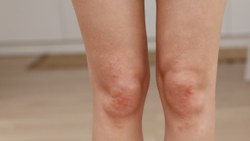Bacaklardaki kırmızı noktaların en yaygın 10 nedeni