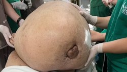 Brezilya'da doktorlar, 45 kiloluk tümörü 2 saatte çıkardı