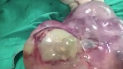 Van'da 15 yaşındaki kızın karnından 7,5 kilogram kitle çıktı