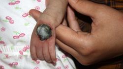 Yanlış takılan serum kelebeği bebeğin elini çürüttü