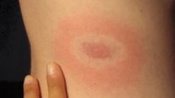 Lyme bakterisi ile Türkiye'de 10 milyon kişi yaşıyor