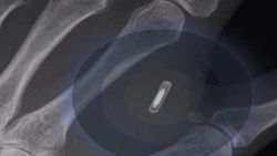 Avustralya'da bir kişi iPhone için eline çip taktırdı