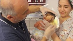 İkiz kafalı bebek Hatay'da dünyaya geldi