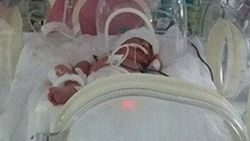 Yoğun bakımdaki Kaan bebek beyin felci geçirdi