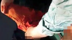 Hastanın karnından çıkan havlu doktoru şoke etti