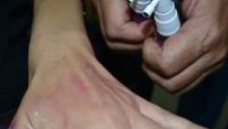 Türk doktor damar bulmaya yarayan sprey icat etti