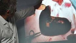Talihsiz kızın midesinden yarım kilo saç çıktı