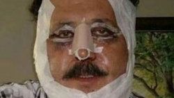 Gökhan Güney estetik oldu