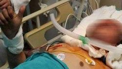 Yüz nakli yapılan hastanın sakalı çıktı