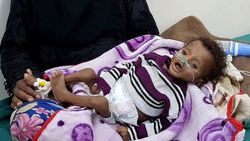 Yemen'de kıtlık en çok çocukları vuruyor
