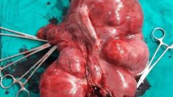 Karın ağrısı çeken kadından 6 kilogramlık kitle çıktı