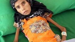 Yemenli kız bir deri bir kemik kaldı