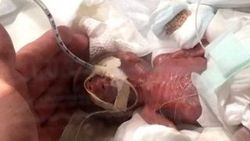 Japonya'da 268 gram doğan bebek taburcu edildi