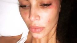 Kim Kardashian sedef hastası