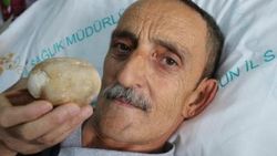 Samsun'da 37 yıllık doktoru şaşırtan taş