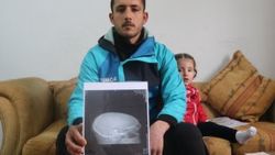 Suriye’deki savaş mağduru kafasındaki mermiyle yaşıyor