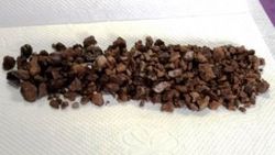Böbreklerinden 500 adet taş çıktı