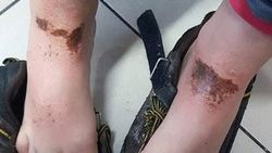 Kar topu oynayan çocukları yakan madde bulundu