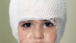 Erzurum'da başına çay dökülen küçük çocuk yandı