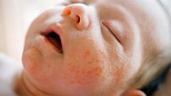 Atopik dermatit nedir