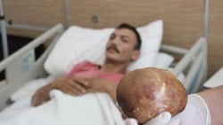 Karaman'da hastaneye başvuran hastanın mesanesinden 1 kilo taş çıktı