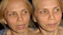 Sertab Erener: Şarkıcı burun estetiği yaptıramaz