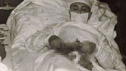 Kendi apandisit ameliyatını yaparak tarihe geçen doktor