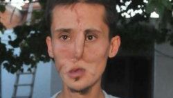 Yüz nakli sevinci sadece 2 saat sürdü