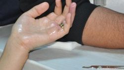 Adanalı genç kıza yüzük operasyonu yapıldı