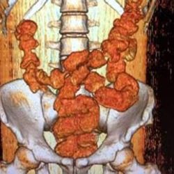 Midesinden 18 prezervatif içinde sıvı kokain çıktı